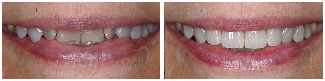 Cosmetic before after treatment photo of patient at Austin, TX, Case-01