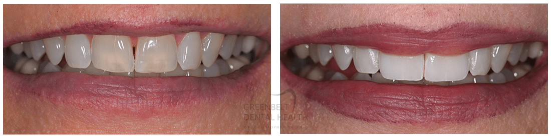 Veneers before and after treatment photo of patient (1) at Austin, TX