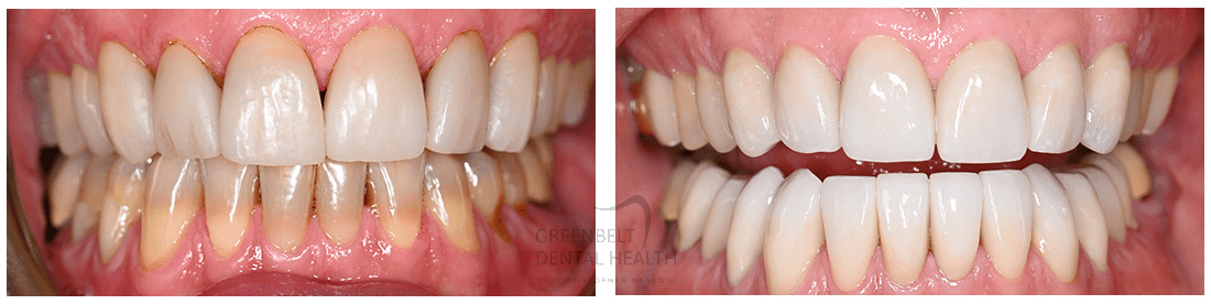 Veneers before and after treatment photo of patient (2) at Austin, TX
