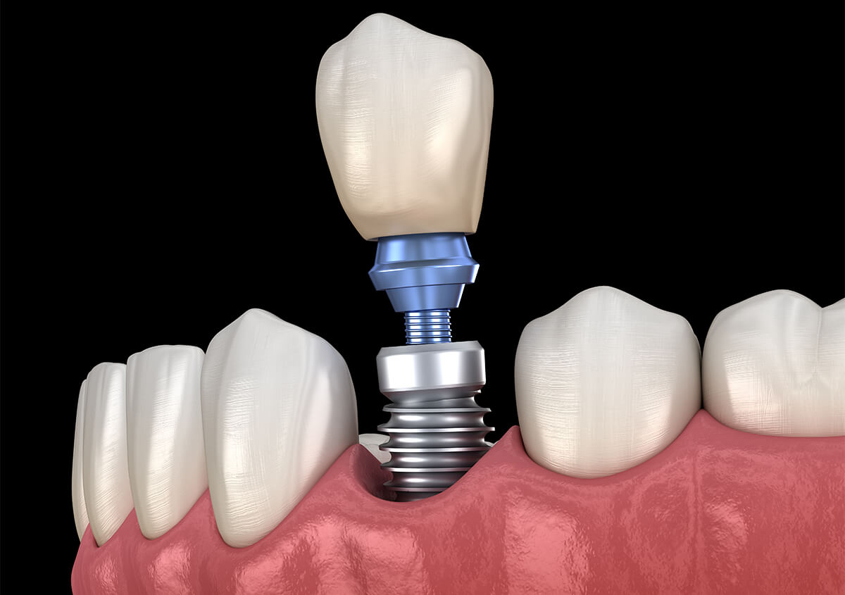 Tooth Implant Process in Austin TX Area