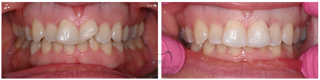 Composite/Bonding before and after treatment photo of patient at Austin, TX, Case-1