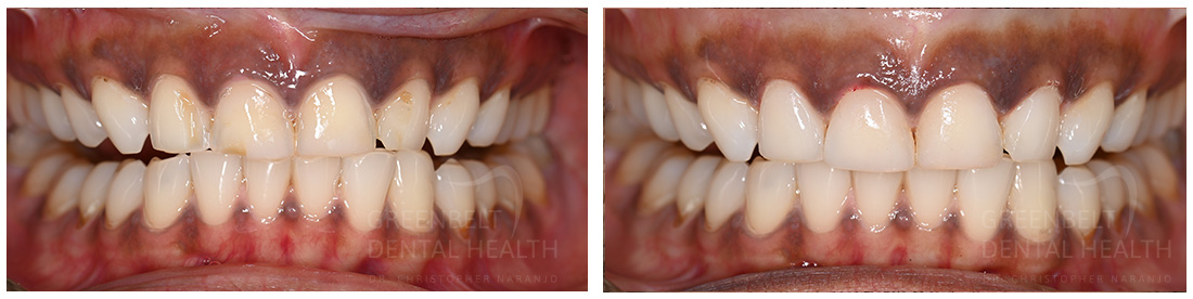 Cosmetic before after treatment photo of patient at Austin, TX, Case-02