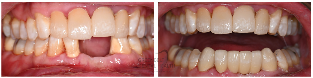 Crowns/Bridge before and after treatment photo of patient at Austin, TX, Case-1