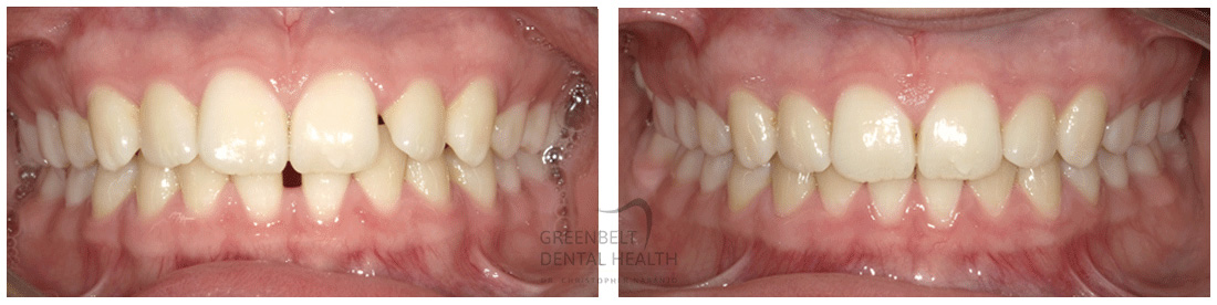 Invisalign - Before After Treatment photo of patient at Austin, TX, Case-01