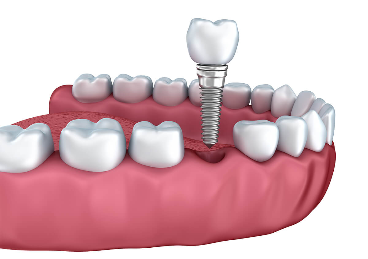 Teeth Implants in Austin TX Area