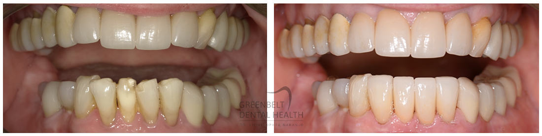 Veneers before and after treatment photo of patient at Austin, TX, Case-3