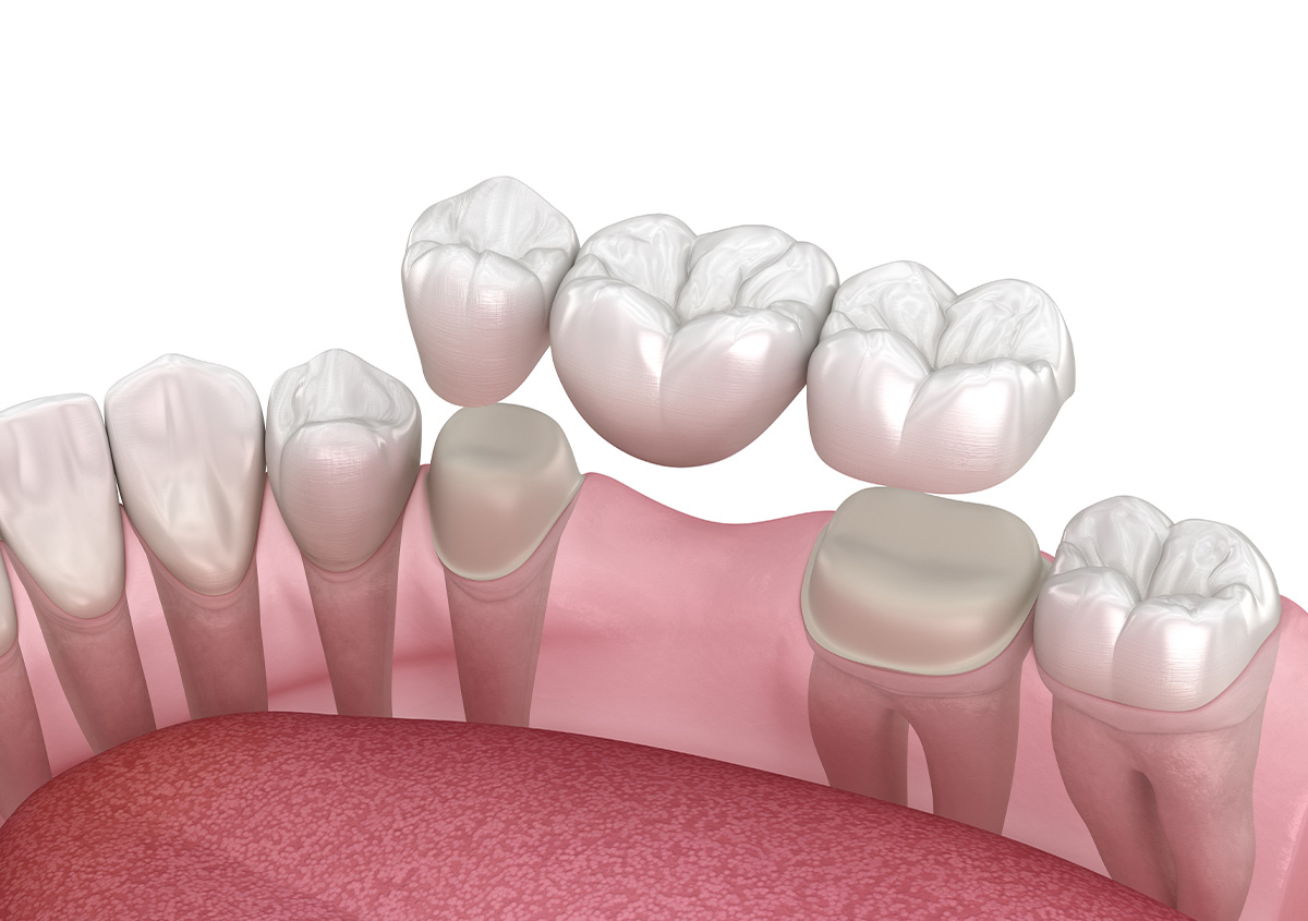 Improve your smile's function and appearance with a dental bridge in Austin TX Area
