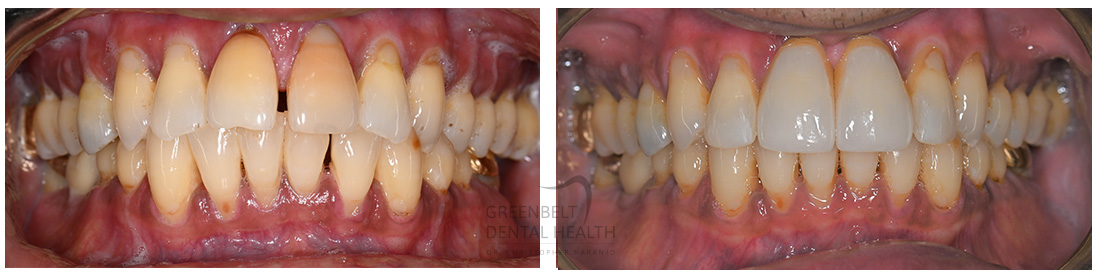 Implant Crowns before and after treatment photo of patient at Austin, TX, Case-1