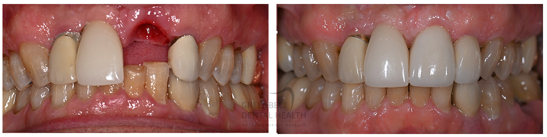 Implant Crowns before and after treatment photo of patient at Austin, TX, Case-2