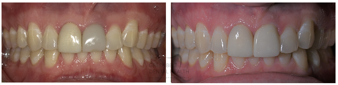 Implant Crowns before and after treatment photo of patient at Austin, TX, Case-3
