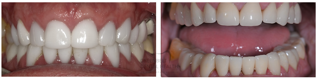 Veneers before and after treatment photo of patient at Austin, TX, Case-4