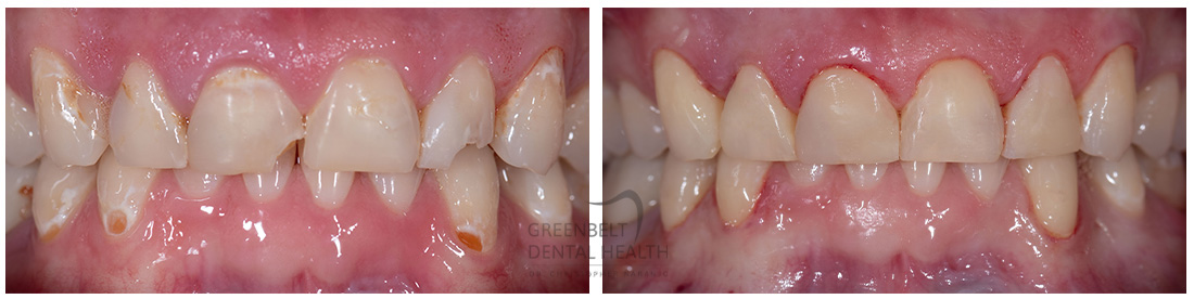 Composite/Bonding before and after treatment photo of patient at Austin, TX, Case-2