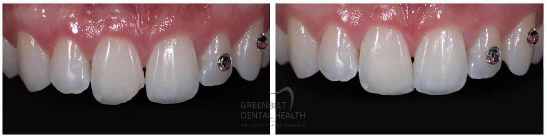 Composite/Bonding before and after treatment photo of patient at Austin, TX, Case-3